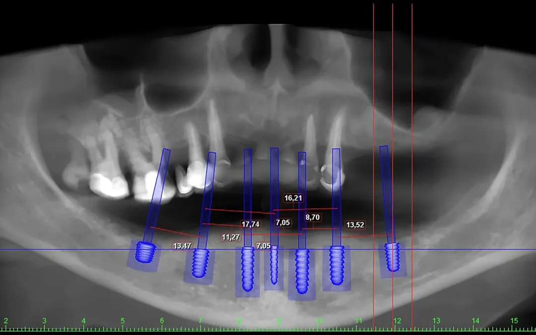 Implantologia e Chirurgia Guidata 3D: il futuro è già nel nostro studio